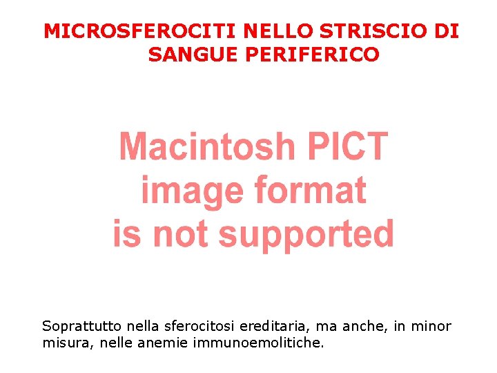 MICROSFEROCITI NELLO STRISCIO DI SANGUE PERIFERICO Soprattutto nella sferocitosi ereditaria, ma anche, in minor