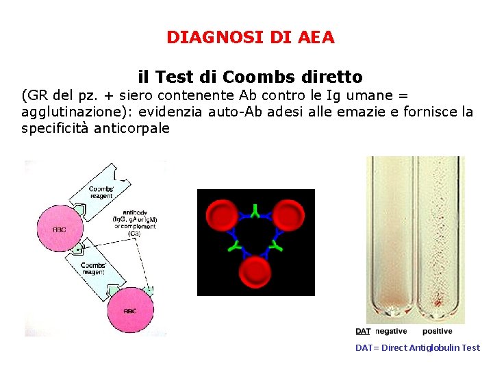 DIAGNOSI DI AEA il Test di Coombs diretto (GR del pz. + siero contenente