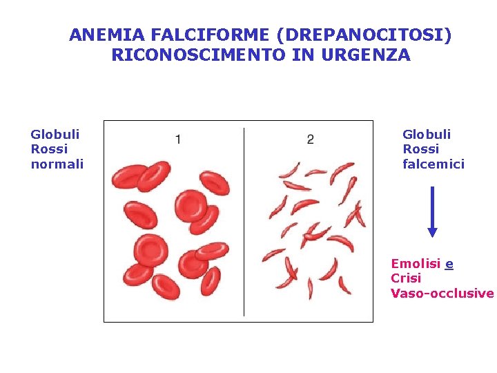 ANEMIA FALCIFORME (DREPANOCITOSI) RICONOSCIMENTO IN URGENZA Globuli Rossi normali Globuli Rossi falcemici Emolisi e