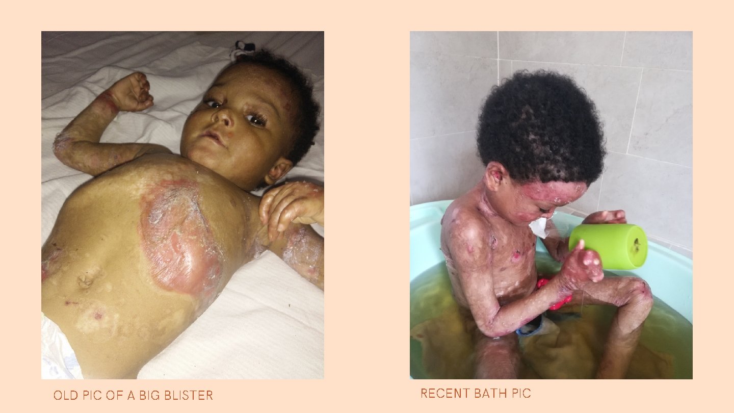 OLD PIC OF A BIG BLISTER RECENT BATH PIC 