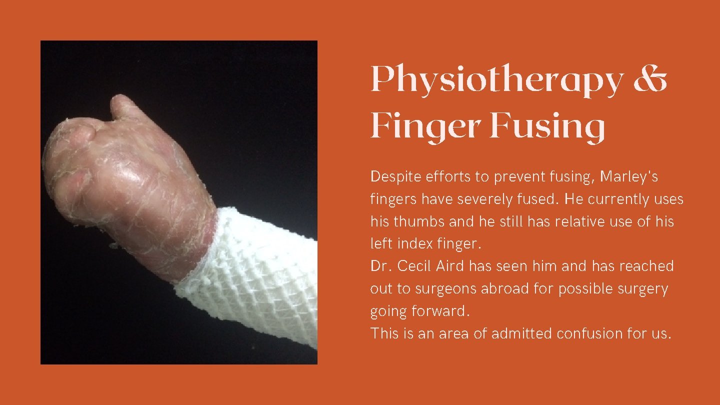 Physiotherapy & Finger Fusing Despite efforts to prevent fusing, Marley's fingers have severely fused.