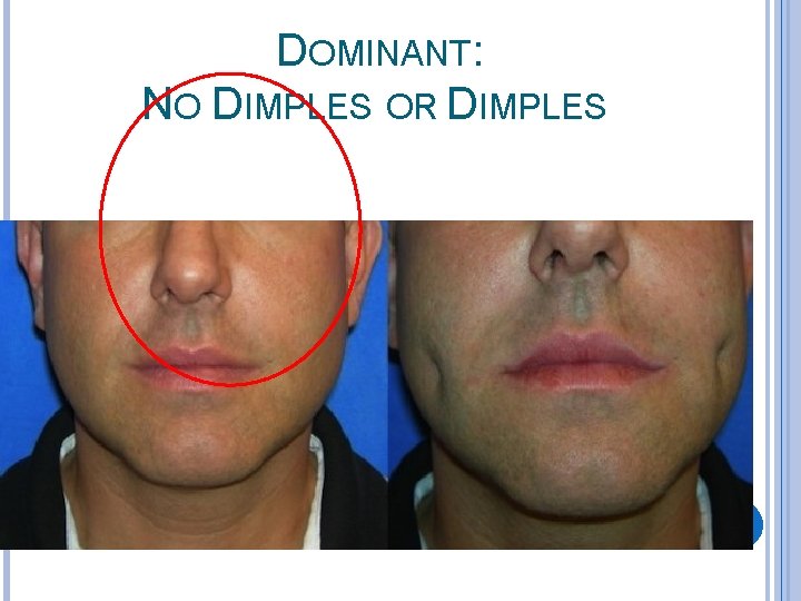 DOMINANT: NO DIMPLES OR DIMPLES 