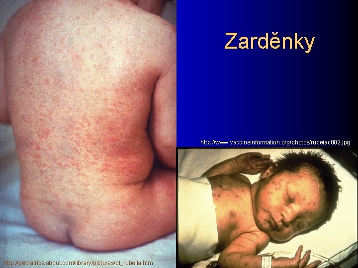Zarděnky http: //www. vaccineinformation. org/photos/rubeiac 002. jpg http: //pediatrics. about. com/library/pictures/bl_rubella. htm 