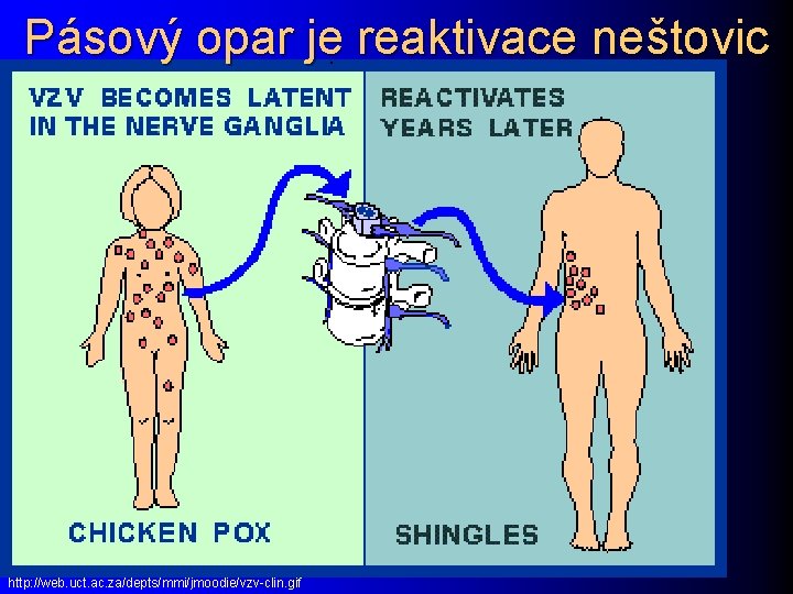 Pásový opar je reaktivace neštovic http: //web. uct. ac. za/depts/mmi/jmoodie/vzv-clin. gif 