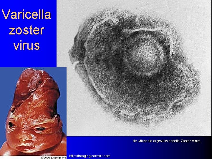 Varicella zoster virus de. wikipedia. org/wiki/Varizella-Zoster-Virus. http: //imaging. consult. com 