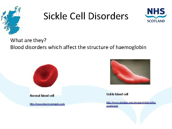 Sickle Cell Disorders What are they? Blood disorders which affect the structure of haemoglobin