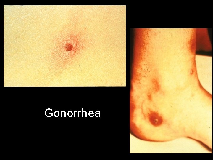 Gonorrhea 