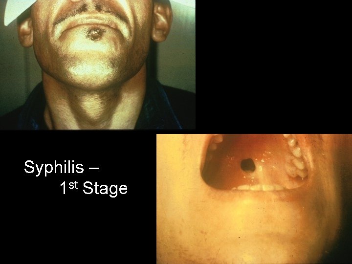 Syphilis – 1 st Stage 