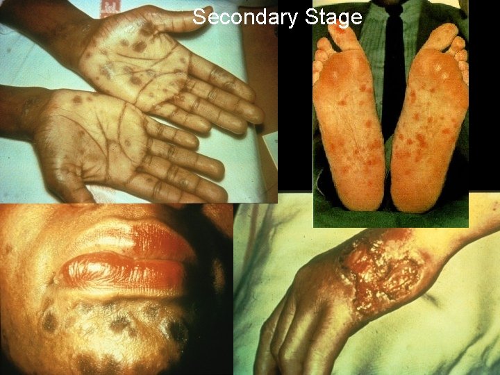 Secondary Stage 