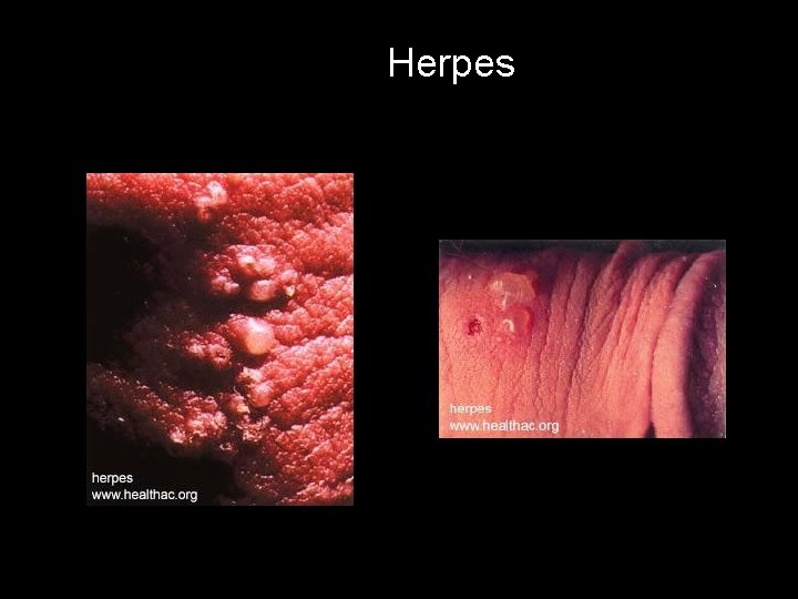 Herpes 