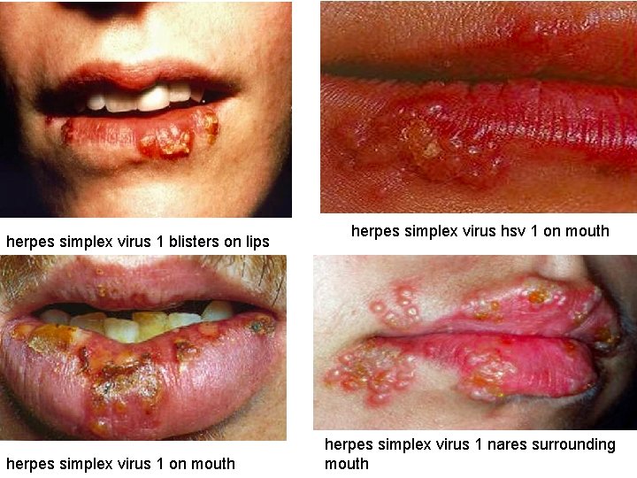 herpes simplex virus 1 blisters on lips herpes simplex virus 1 on mouth herpes