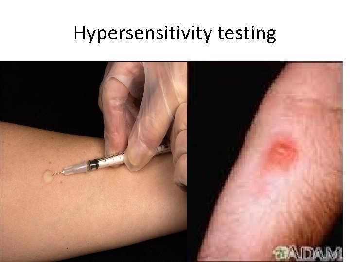 Hypersensitivity testing 