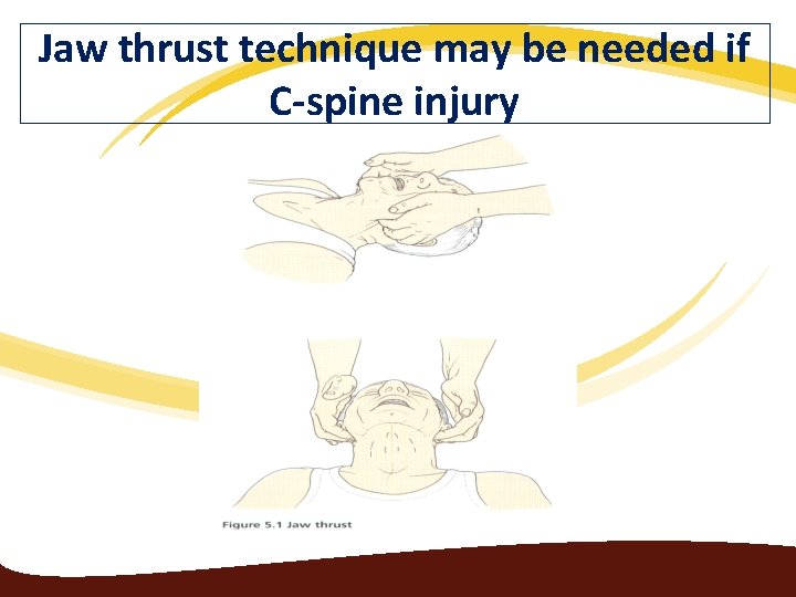 Jaw thrust technique may be needed if C-spine injury 