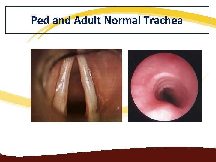 Ped and Adult Normal Trachea 