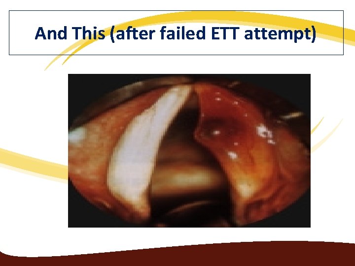 And This (after failed ETT attempt) 