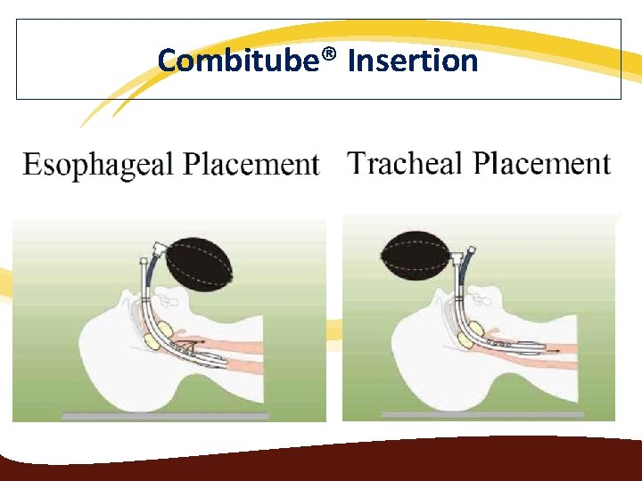 Combitube® Insertion 