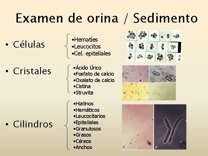 Examen de orina / Sedimento • Células • Cristales • Cilindros • Hematíes •