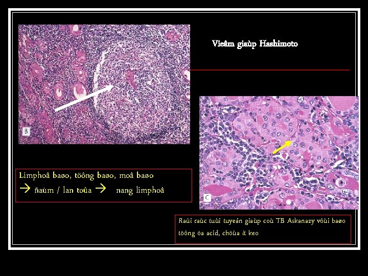 Vieâm giaùp Hashimoto Limphoâ baøo, töông baøo, moâ baøo ñaùm / lan toûa nang