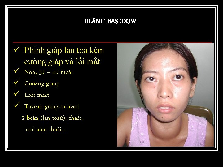 BEÄNH BASEDOW ü Phình giáp lan toả kèm cường giáp và lồi mắt ü