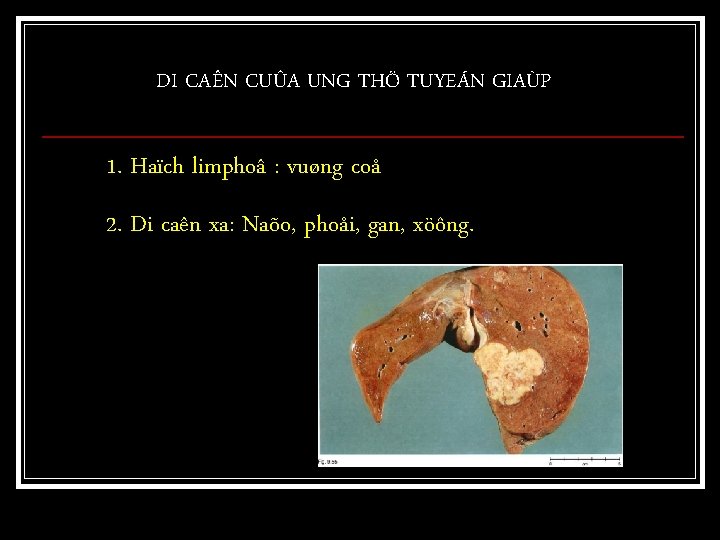 DI CAÊN CUÛA UNG THÖ TUYEÁN GIAÙP 1. Haïch limphoâ : vuøng coå 2.