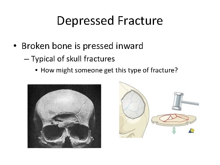 Depressed Fracture • Broken bone is pressed inward – Typical of skull fractures •