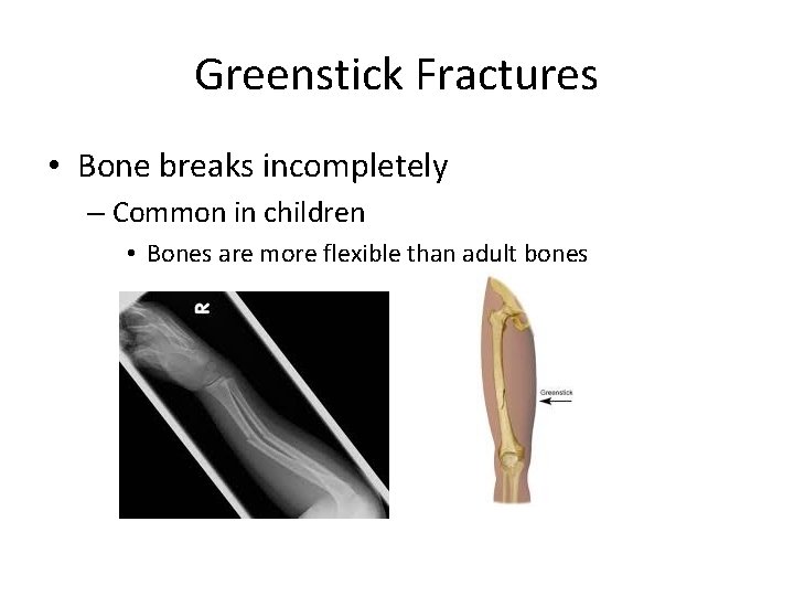 Greenstick Fractures • Bone breaks incompletely – Common in children • Bones are more