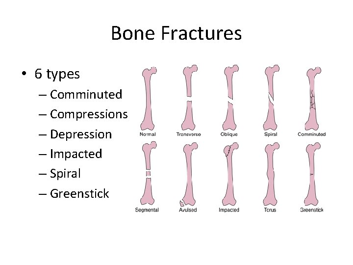 Bone Fractures • 6 types – Comminuted – Compressions – Depression – Impacted –