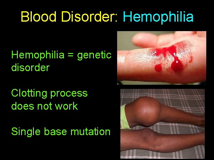 Blood Disorder: Hemophilia = genetic disorder Clotting process does not work Single base mutation
