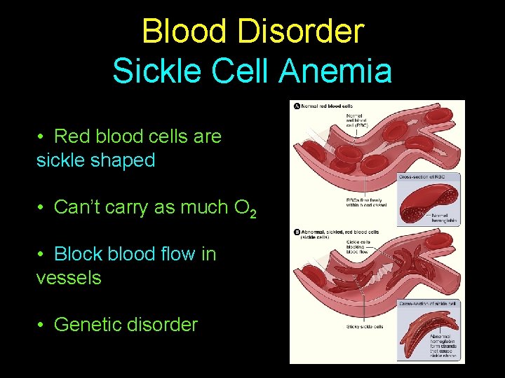 Blood Disorder Sickle Cell Anemia • Red blood cells are sickle shaped • Can’t