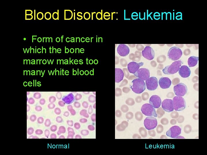 Blood Disorder: Leukemia • Form of cancer in which the bone marrow makes too