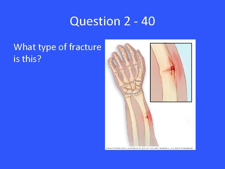 Question 2 - 40 What type of fracture is this? 