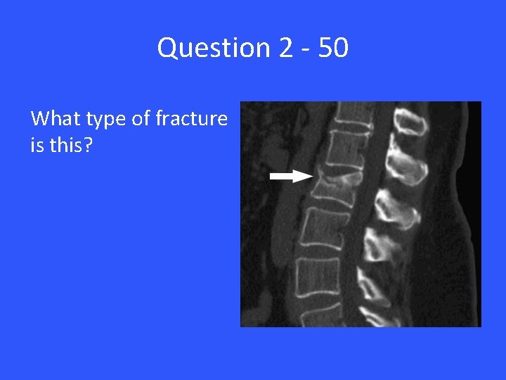 Question 2 - 50 What type of fracture is this? 