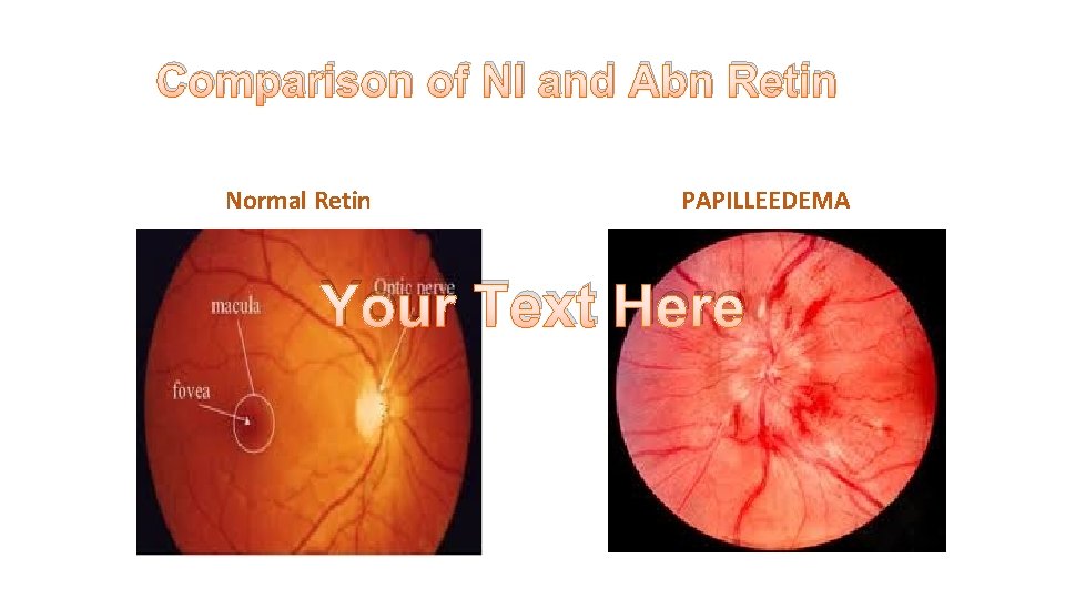 Comparison of Nl and Abn Retin Normal Retin PAPILLEEDEMA Your Text Here 