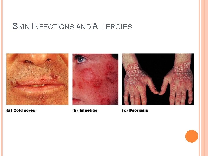 SKIN INFECTIONS AND ALLERGIES 