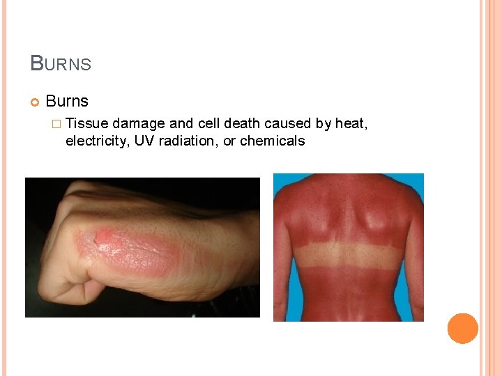 BURNS Burns � Tissue damage and cell death caused by heat, electricity, UV radiation,