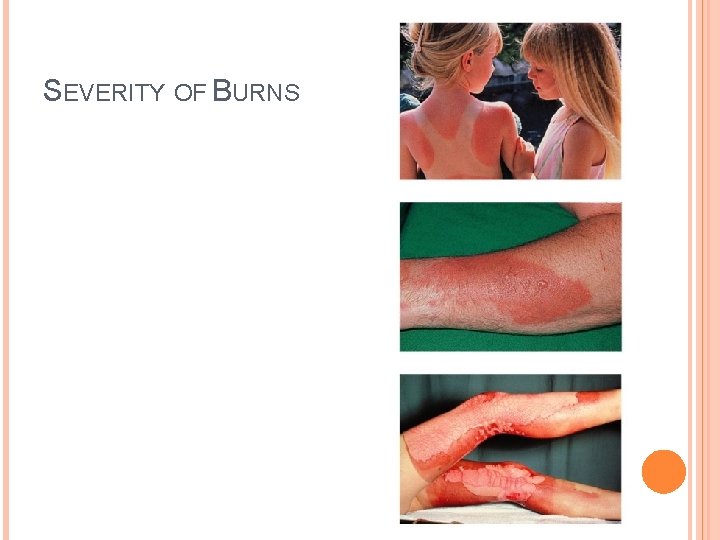SEVERITY OF BURNS 