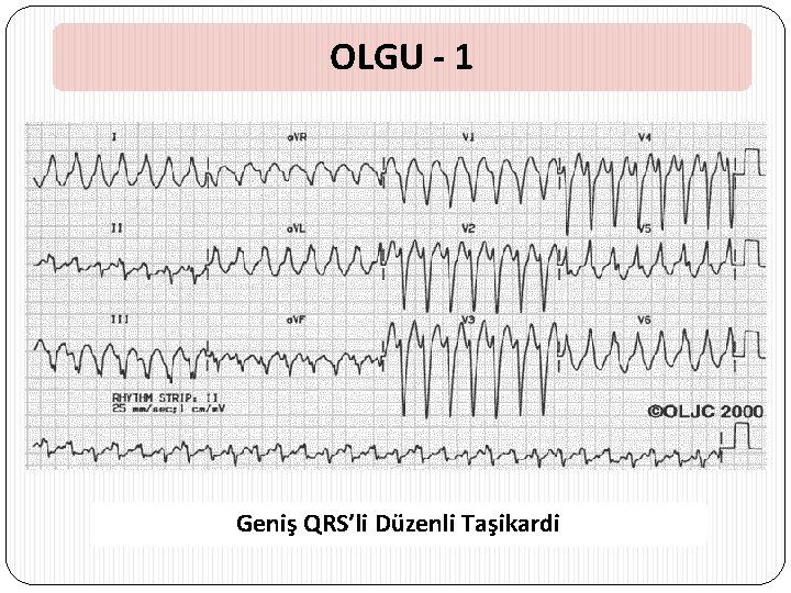 OLGU - 1 Geniş QRS’li Düzenli Taşikardi 