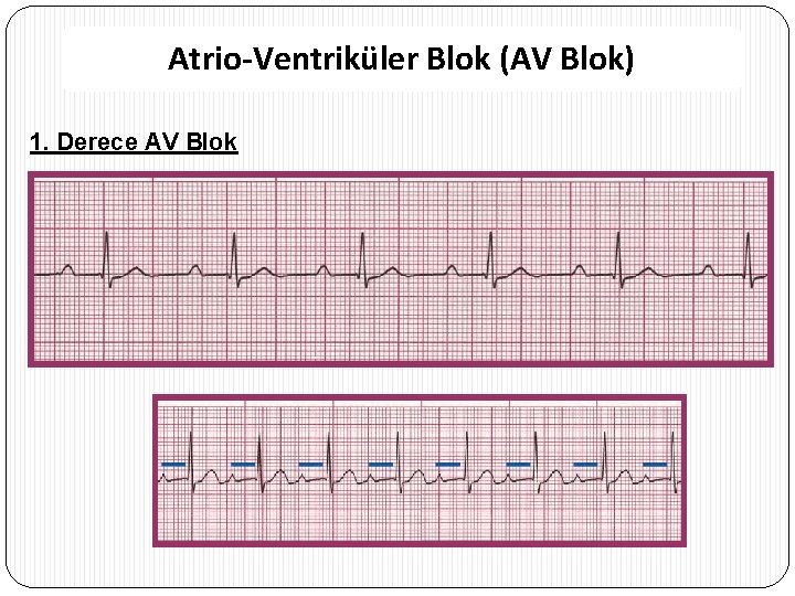 Atrio-Ventriküler Blok (AV Blok) 1. Derece AV Blok ATRİOVENTRİKÜLER BLOK (AV BLOK) 