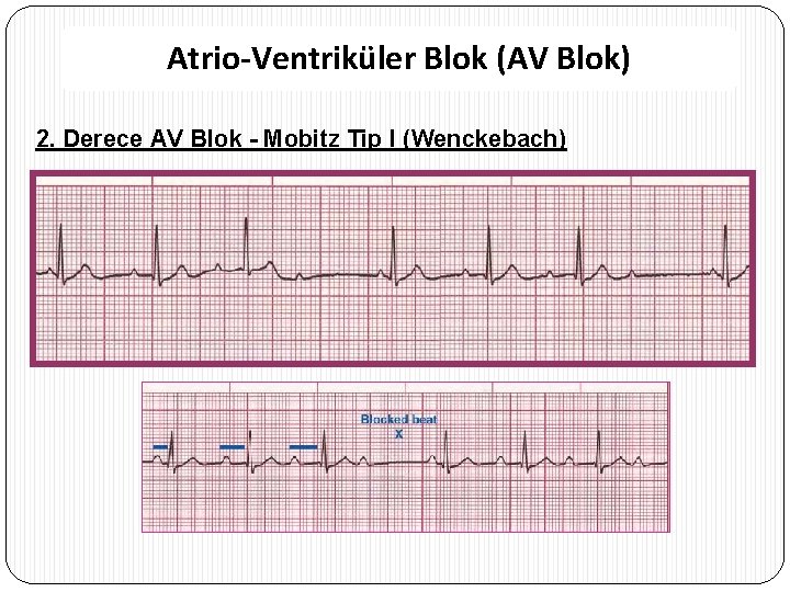 Atrio-Ventriküler Blok (AV Blok) 2. Derece AV Blok - Mobitz Tip I (Wenckebach) 