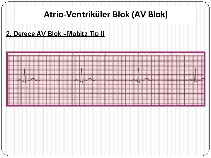 Atrio-Ventriküler Blok (AV Blok) 2. Derece AV Blok - Mobitz Tip II 