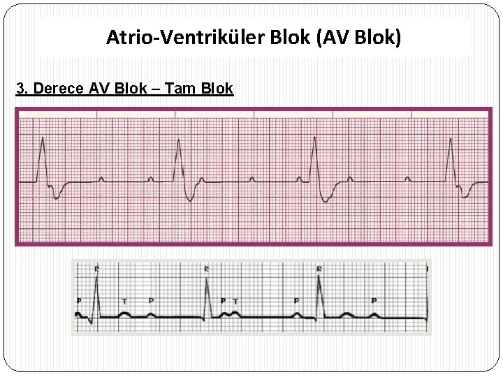 Atrio-Ventriküler Blok (AV Blok) 3. Derece AV Blok – Tam Blok 