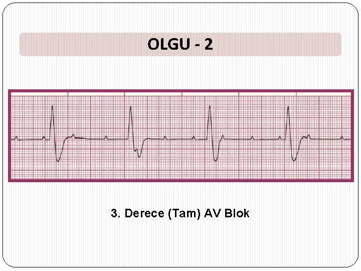 OLGU - 2 3. Derece (Tam) AV Blok 