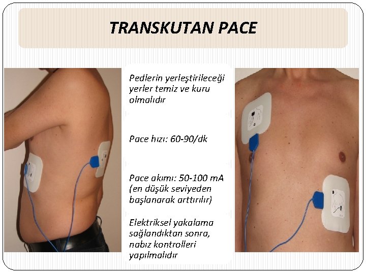 TRANSKUTAN PACE Pedlerin yerleştirileceği yerler temiz ve kuru olmalıdır Pace hızı: 60 -90/dk Pace