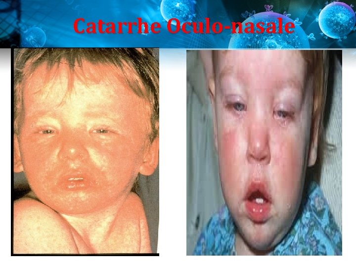Catarrhe Oculo-nasale Catarrhe Oculo-nasale