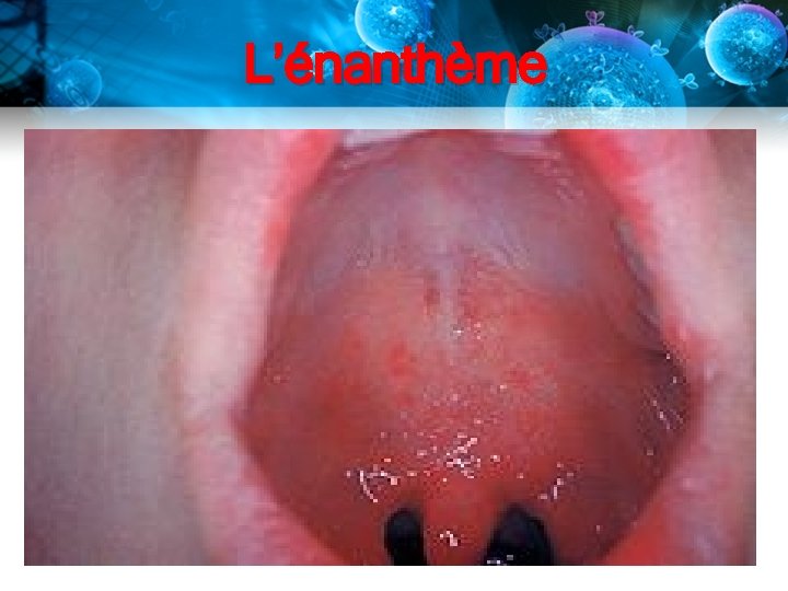 L’énanthème L’énanthème