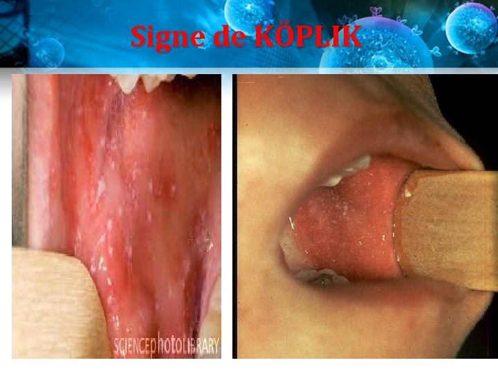 Signe de KÖPLIK Signe de KÖPLIK