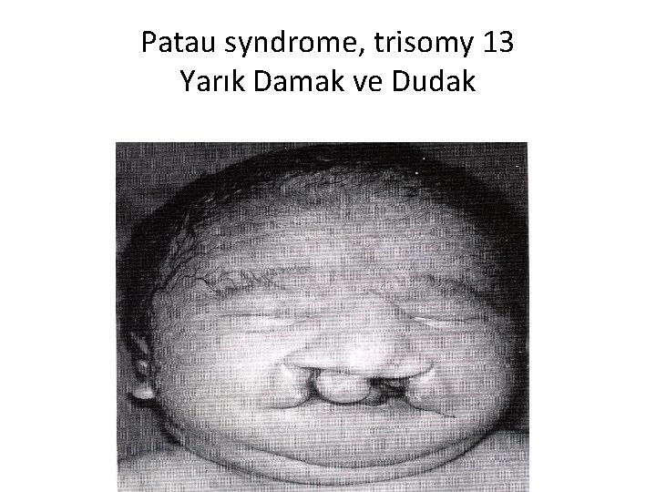 Patau syndrome, trisomy 13 Yarık Damak ve Dudak 47, XX, +13 or 47, XY,