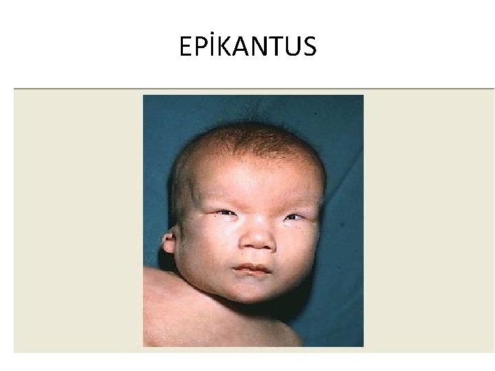 EPİKANTUS 