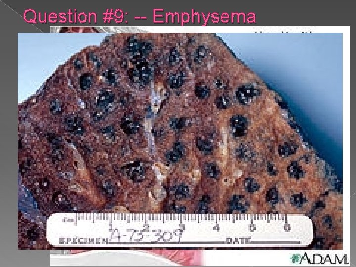 Question #9: -- Emphysema 
