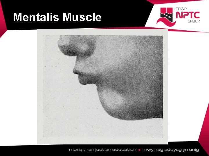 Mentalis Muscle  Mentalis Muscle